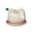 Ohio Forge Multi-Use Diamond, Sterile